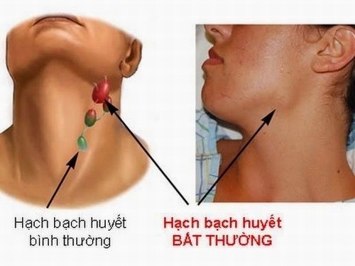 Không nên chủ quan trước các hiện tượng viêm hạch bạch huyết