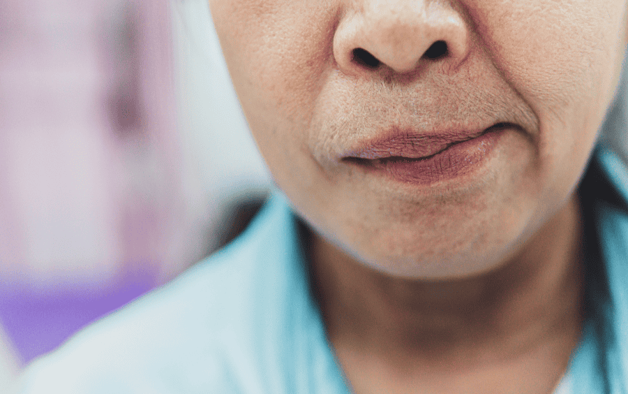 Mất cân bằng giữa hai bên hoạt động thần kinh là một trong những dấu hiệu quả mặt lệch