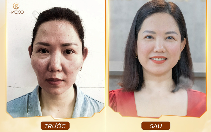 Khách hàng trước và sau khi sử dụng liệu trình chỉnh cốt ABA Method Hadoo Moon