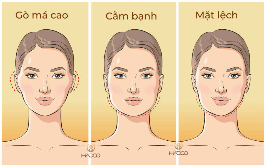 người có khuôn mặt thiếu cân đối như mặt lệch, hàm bạnh... nên chỉnh cốt thẩm mỹ