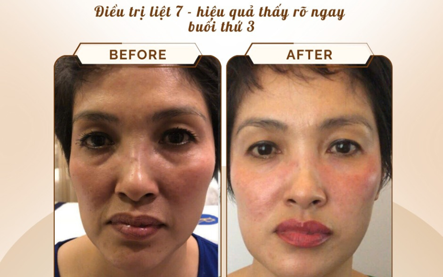 Điều trị liệt 7 bằng phương pháp thải độc hệ bạch huyết tại Hadoo